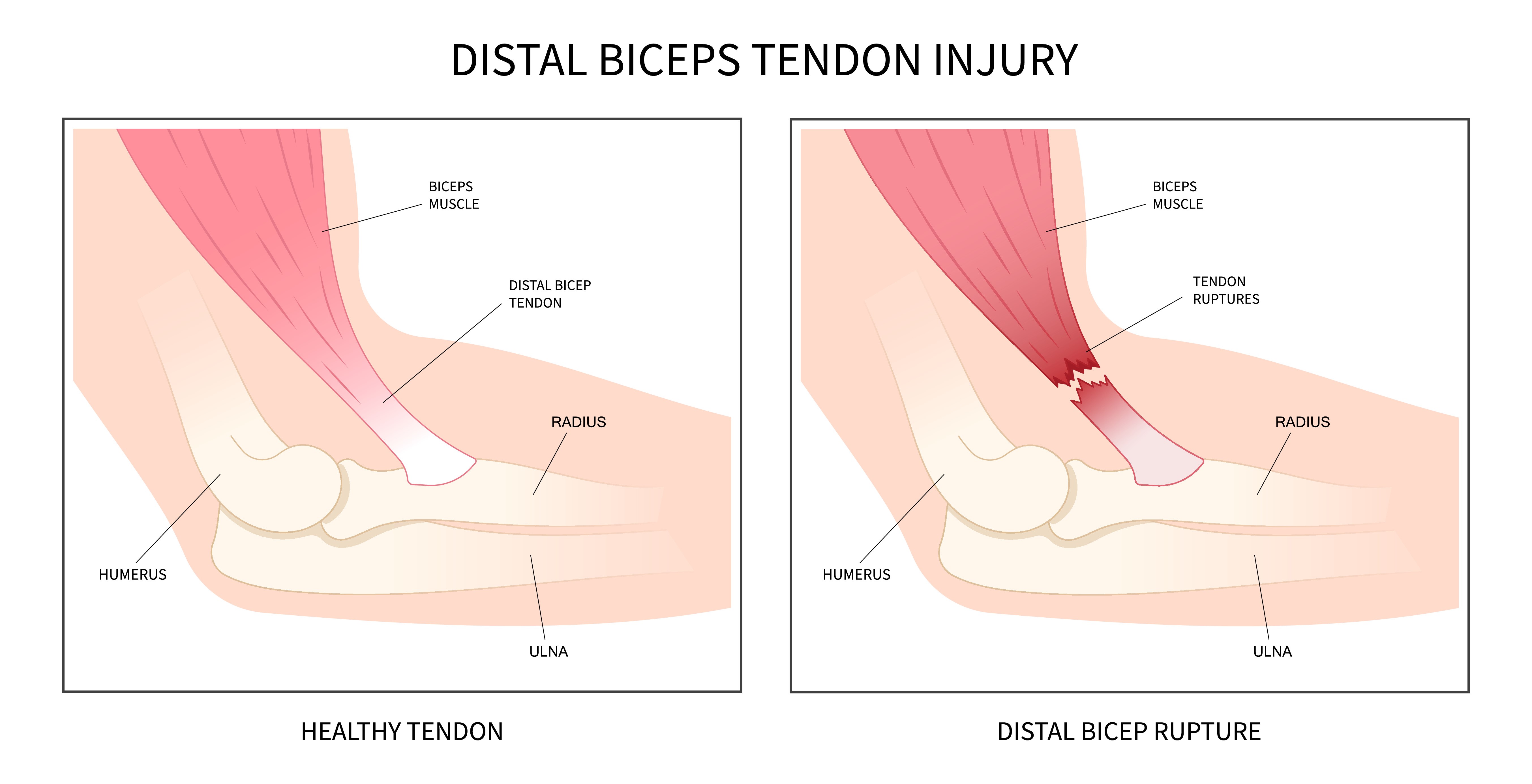 distal biceps rupture
